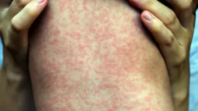 Why the Measles Outbreak Is Serious—and How Vaccines…